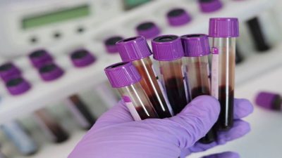 Hematoloji alanında önemli uyarılarda bulunan uzmanlar, rutin kan testlerinde ortaya